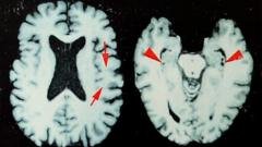 Brain disease in dead NFL players ‘higher than previously shown’